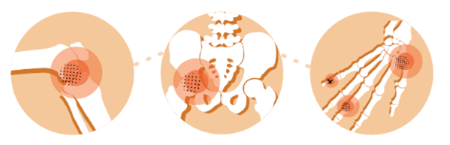 3 pics of parts of the skeleton- knee, hip, hand- with pain radiating